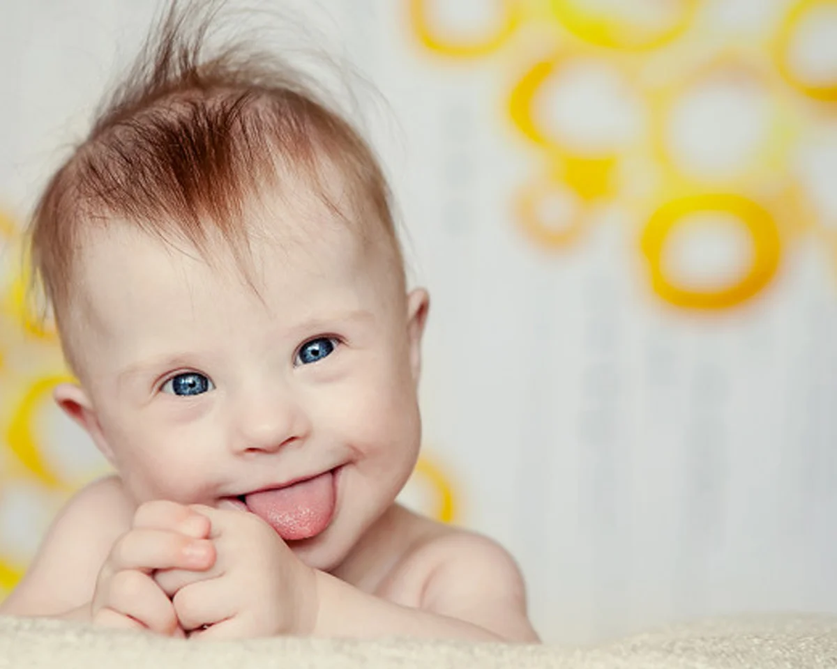 خصوصیات کودکان سندرم داون