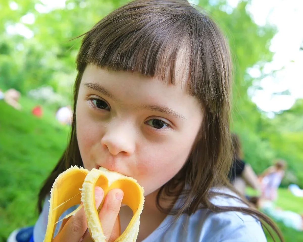 تغذیه کودکان سندرم داون