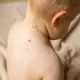 علائم آبله مرغان در کودکان