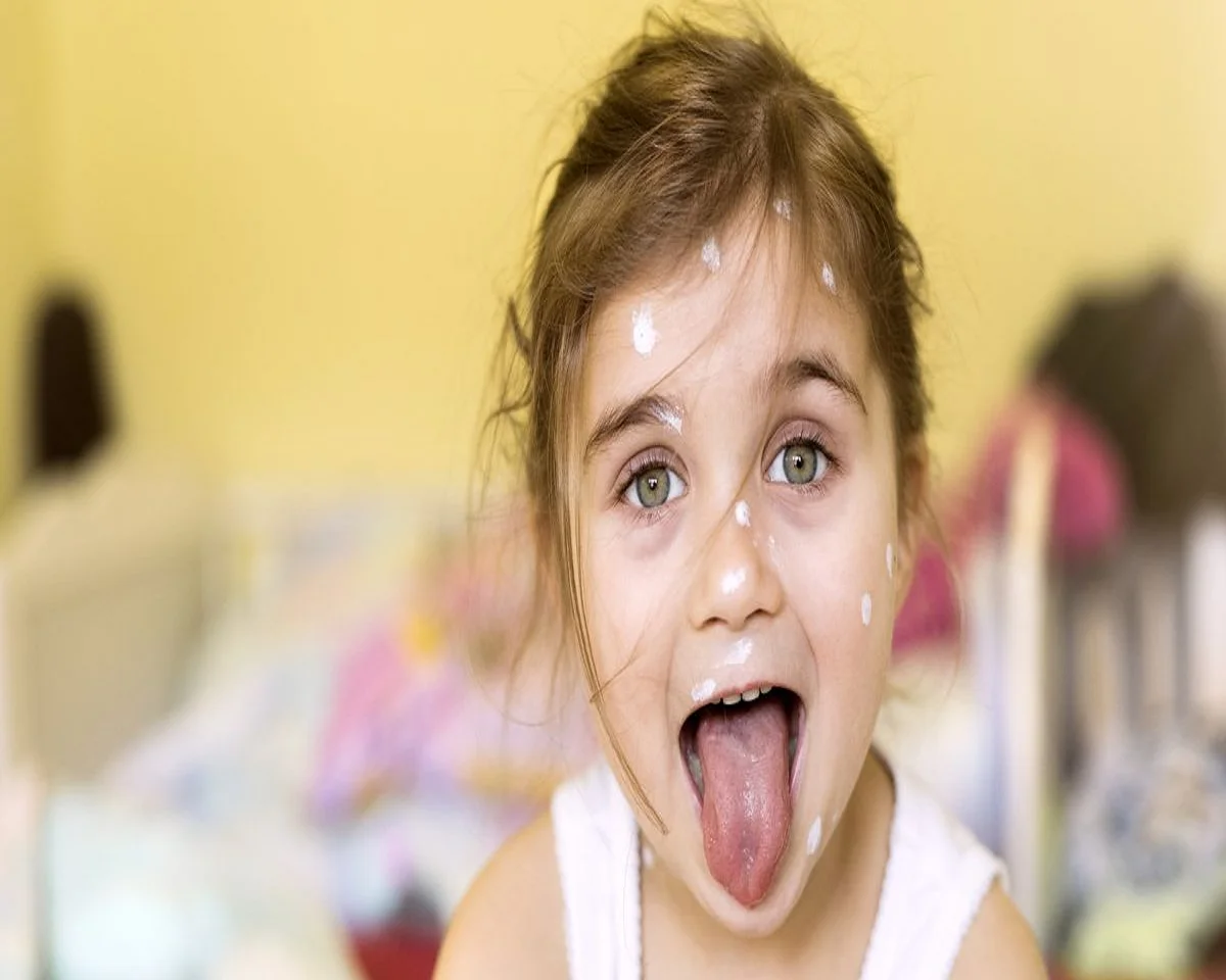 آبله مرغان در دهان کودک